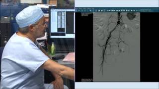 24 common right iliac stenting recanalisation of external left iliac incathlabcom [upl. by Witt]