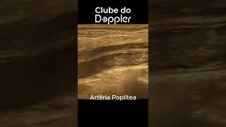 Embolo na artéria poplítea curto doppler dopplervascular embolia [upl. by Nysilla]