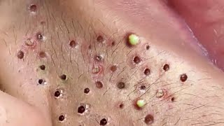 Treatment Of Blackheads And Hidden Acne  90 [upl. by Rettuc931]