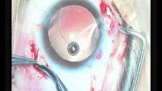 scleral fixation of foldable IOL in the sulcus above the decentered bag [upl. by Noevart]