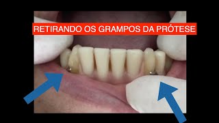 DENTADURA HÍBRIDA APOIADA EM IMPLANTES E DENTES [upl. by Marriott780]