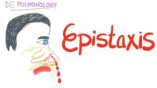 Epistaxis nosebleed Causes and Management [upl. by Kipp]