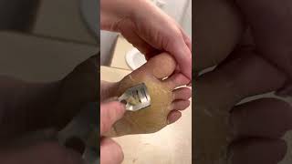 Feet Shaving Ball of Foot  Jan 12 2023  Diffuse Epidermolytic Palmoplantar Keratoderma [upl. by Kirre]