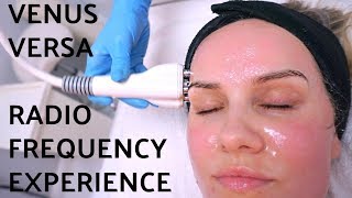 Venus Versa Wrinkle Treatment Experience [upl. by Dhiren]