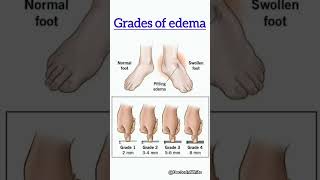 Grades of edema  viralshort gradesofedema edema pittingedema trending [upl. by Aon]