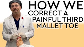 How We Correct A Painful Third Mallet Toe [upl. by Ahsenrad]