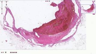 Atheromatous Plaque with Thrombosis  Histopathology [upl. by Ades]