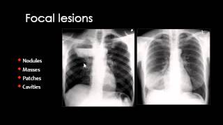 Chest XRay CXR in Arabic  Prof Mamdouh Mahfouz [upl. by Oruam]