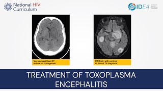 MiniLecture Series Treatment of Toxoplasma Encephalitis [upl. by Ylek]