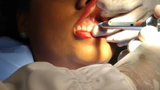 Frenillectomia labial superior parte 1 [upl. by Dex]