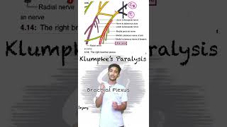 “Understanding Klumpke’s Paralysis Causes Injuries and Clinical Conditions Explained” [upl. by Ardnikal574]