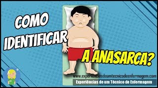 Como Identificar a Anasarca [upl. by Acnayb]