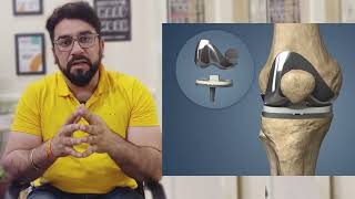 OA knee braces perfect alternate of kneesurgey for osteoarthritis patient घुटने के दर्द से राहत [upl. by Dorin426]