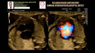 Atrioventricular Septal Defect [upl. by Erv]