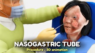 Nasogastric NG Tube Procedure  3D animation [upl. by Ahsemal]