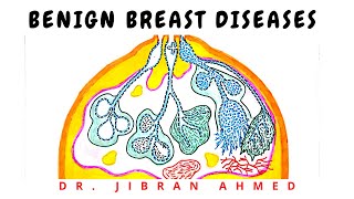 BENIGN BREAST DISEASE [upl. by Jueta]