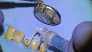 34 Live Root Canal Retreatment Procedure [upl. by Chlo707]