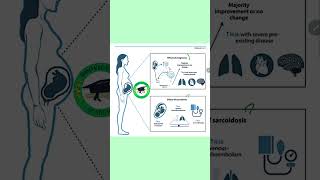 Sarcoidosis affects pregnancy mrcogcourses duringpregnancy mrcogpart2 mrcogpart3 sarcoidosis [upl. by Aicel587]