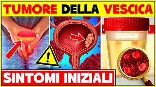 5 Segni e Sintomi Iniziali Del Tumore Alla Vescica  Cancro Alla Vescica Sintomi Precoci [upl. by Bouldon]