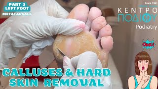 Part 3 Calluses amp Hard Skin Removal feet κεντροποδιου foot podologos podiatrist corn footcare [upl. by Harness671]