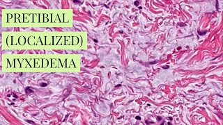 Pretibial localized myxedema explained by a dermatopathologist unknown 12 dermpathiseasy [upl. by Nwadrebma]