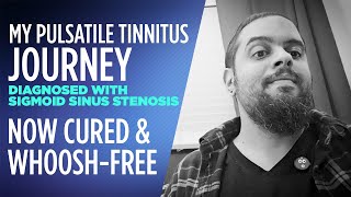 I cured my Pulsatile Tinnitus and now whooshfree diagnosed with Sigmoid Sinus Stenosis [upl. by Caines]