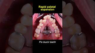 Expand upper teeth with rapid palatal expander braces orthodontist dentist [upl. by Dyob]