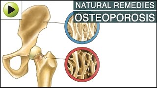 Aches amp Pains  Osteoporosis  Natural Ayurvedic Home Remedies [upl. by Imot]