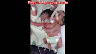 Neonatal Cases  Rare conjoined twins with two heads one body Dicephalic parapagus twin neonate [upl. by Onaicul]