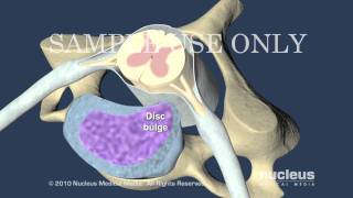 Cervical Disc Herniation [upl. by Silberman]