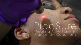 PicoSure Laser for Acne Scars amp Pigmentation [upl. by Fattal11]