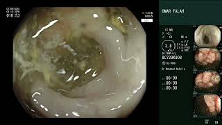 familial adenomatous polyposis [upl. by Gillie]