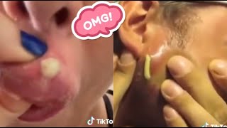 Satisfying Blackhead Removal Compilation  Best Techniques for Clear Skin [upl. by Janeczka577]