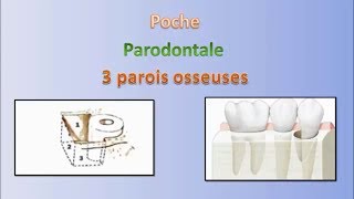 Les poches en parodontologie  Pocket in periodontology [upl. by Latsryk]