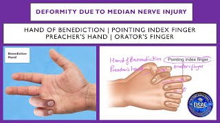 Hand of Benediction  Pointing index finger  Median nerve injury  Preachers hand Orators finger [upl. by Navlys]