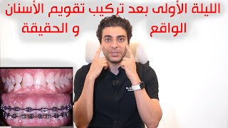 الليلة الأولى بعد تركيب تقويم الأسنان ، التوقع و الحقيقة [upl. by Melamie]