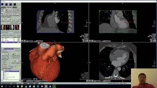 Anomalous LCX from right coronary sinus with retroaortic course [upl. by Raye]