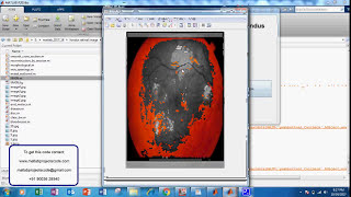 RETINAL BLOOD VESSEL SEGMENTATION FROM FUNDUS IMAGE [upl. by Farlay]