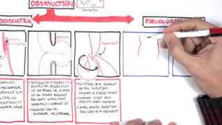 Bowel Obstruction  Causes and Pathophysiology [upl. by Akinahc644]