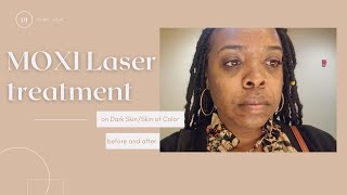 MOXI Laser treatment for hyperpigmentation on dark skin [upl. by Lirret]