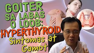 Goiter sa Labas o Loob Hyperthyroid Sintomas at Gamot  Payo ni Doc Willie Ong 212 [upl. by Melisande574]