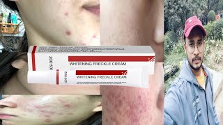 zoo son whitening freckle cream  honest review [upl. by Merrile]