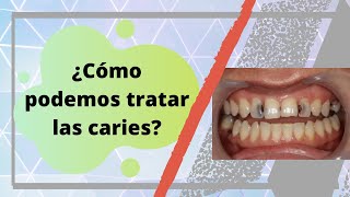 ¿Qué tratamientos hay para las caries  Dr Alvaro Campos [upl. by Rodrique772]