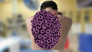 ASMR Back Treatment Tripophobia Animation Cleaning Worm Satisfied asmr [upl. by Aniat]