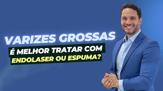 Tratamento de varizes grossas Endolaser ou espuma Entenda qual a melhor técnica varizes [upl. by Tihw]