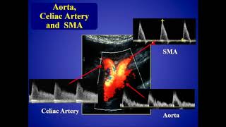 Mesenteric Ischemia [upl. by Radmen]