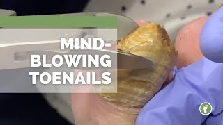 MIND🤯BLOWING TOENAILS [upl. by Yelda]