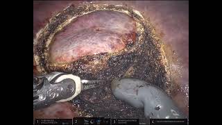 Robotic Microwave Ablation  Partial hepatectomy [upl. by Jada]