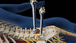 Lumbar Fusion of L5 S1 Animation [upl. by Cedric638]