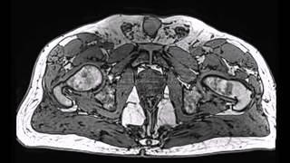 Pelvis MR [upl. by Floyd]